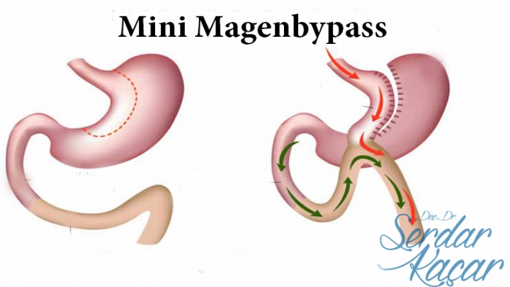 Mini Magenbypass